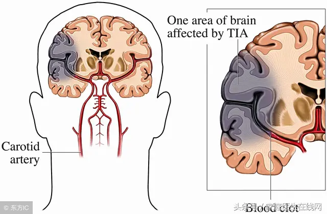 sudden-appearance-of-these-symptoms-is-a-sign-of-stroke-doing-these-2