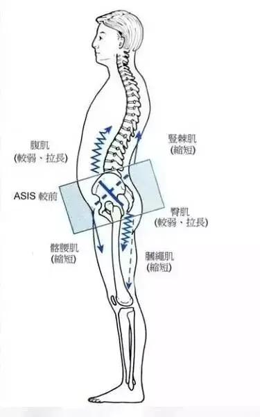 常见的骨盆前倾腰椎段压迫疼痛处理思路