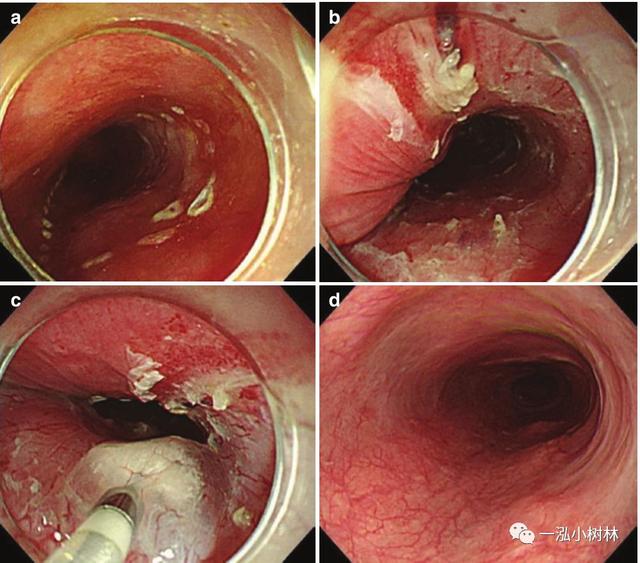 上消化道肿瘤内镜治疗策略系列之早期食管癌eplpm内镜集锦