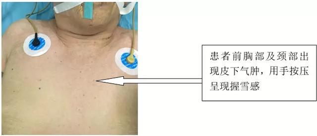 术中出现了皮下气肿该如何处理