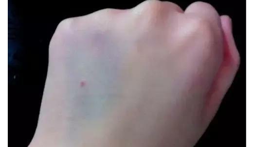输液后手背出现淤青的预防和处理您知道吗