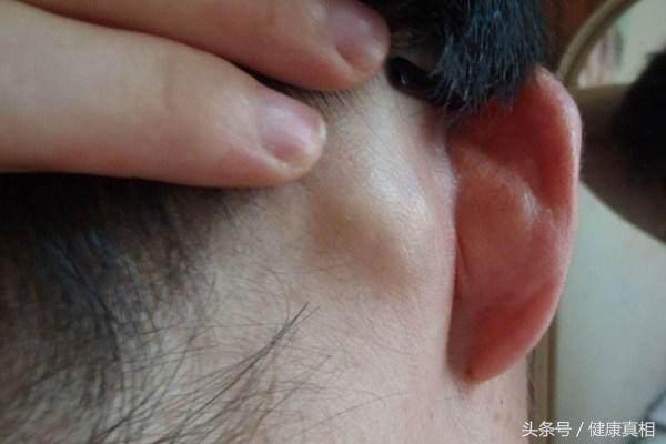 风疹淋巴结肿大_健康症状网
