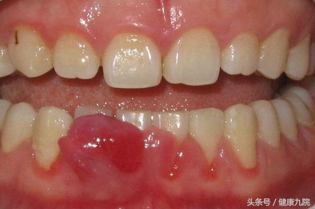 水平升高,原有的牙龈慢性炎症加重,使牙龈肿胀或形成龈瘤样的改变(图1
