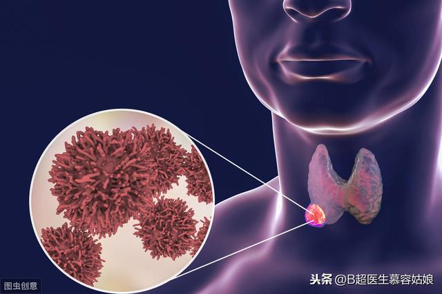 嗓子疼有異物感聲音嘶啞竟然被檢查出是甲狀腺癌恐怖