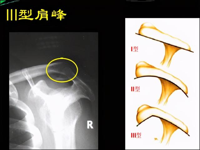 临床知识肩袖损伤