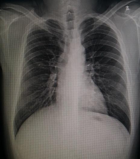 今天上午重度桶状胸的小手术