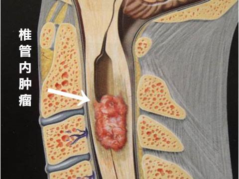 成人脊髓下端位置的症状及缓减治疗