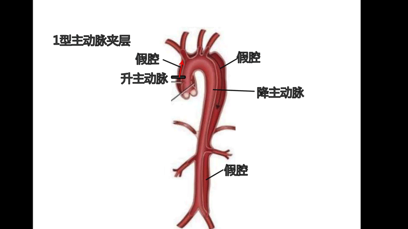 血压升高后,血流对主动脉壁的压力增加,血管弹性和顺应性变差.