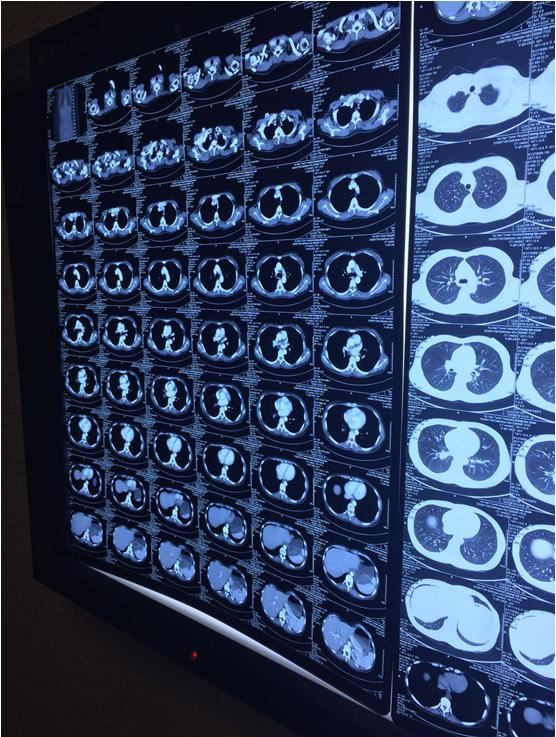就诊指南 一招告诉您 如何用手机拍摄清晰胸部ct影像片_健康症状网
