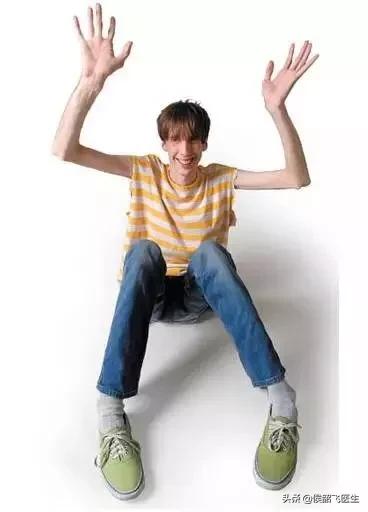 被称为蜘蛛人的马凡氏综合征这个天才病是福还是祸