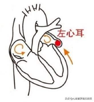 90%的房颤血栓因为它——心脏的"小耳朵"左心耳