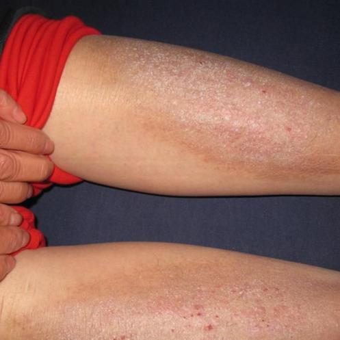 季节性变化,尤其是神经性皮炎多发,如何应对?