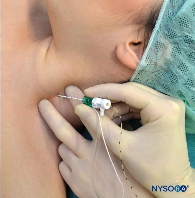 斜角肌入路臂丛神经阻滞