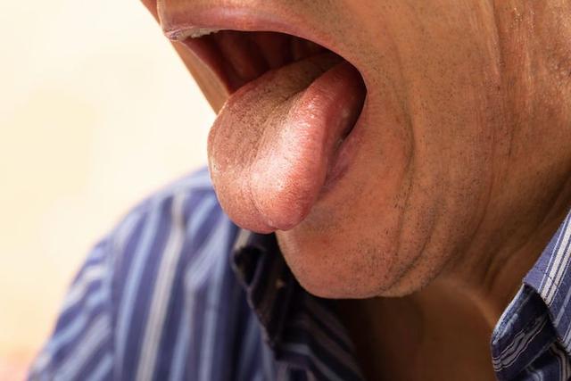 舌苔颜色反映身体疾病｜舌苔变白会易患感冒 苔苔黄即是肠胃差？