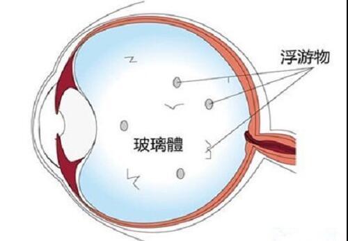 玻璃体混浊症状(玻璃体混浊症状怎么办)-第1张图片-鲸幼网