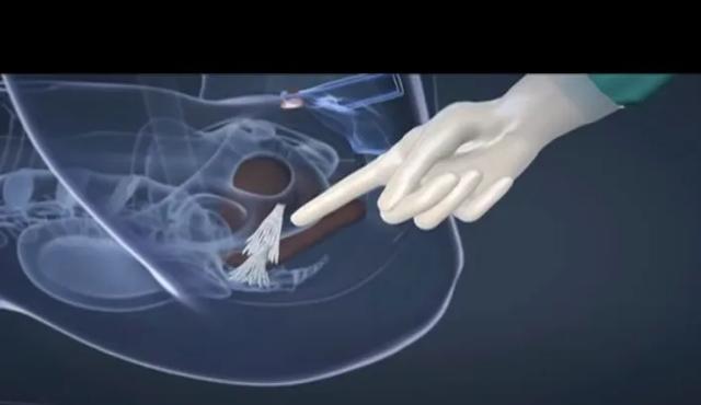 跨性别者的变性手术和人生梦想成为真正的女孩的艰辛之路