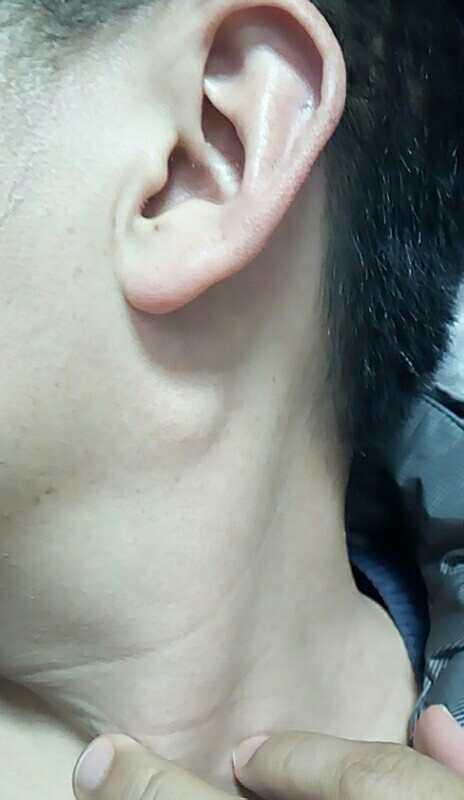 鼻涕带血可能是鼻咽癌看完你就明白了