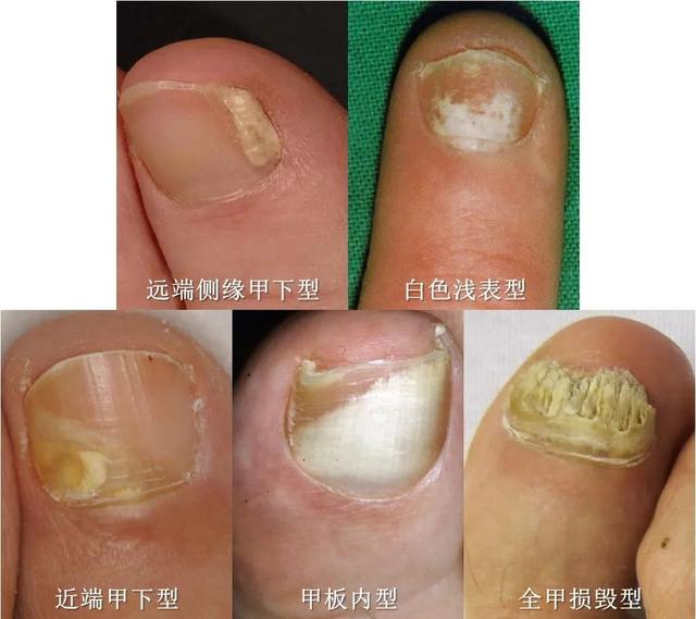 甲真菌病临床亚型