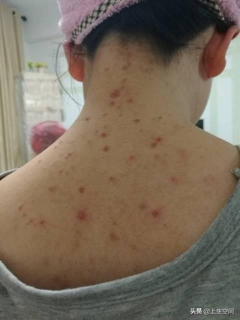 前胸后背长痘痘4招教你轻松搞定