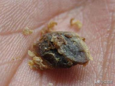 有耳屎怎么办?_健康症状网