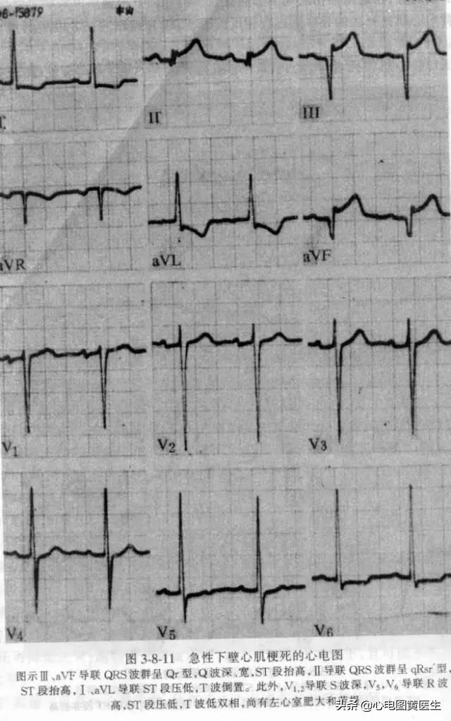 各型冠心病的心电图诊断与鉴别诊断_健康症状网