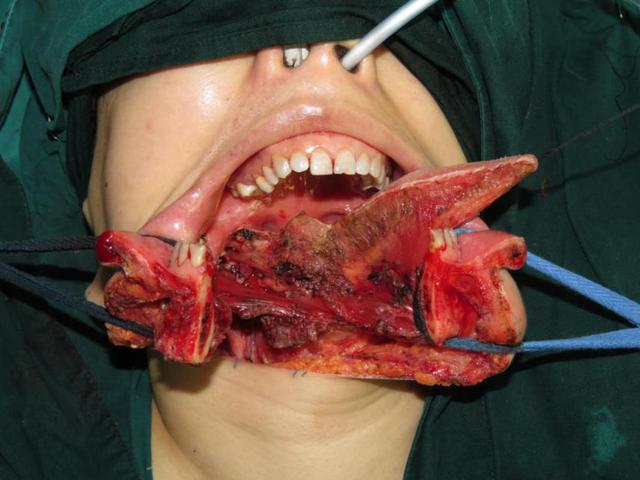 口腔癌做完手术的图片图片