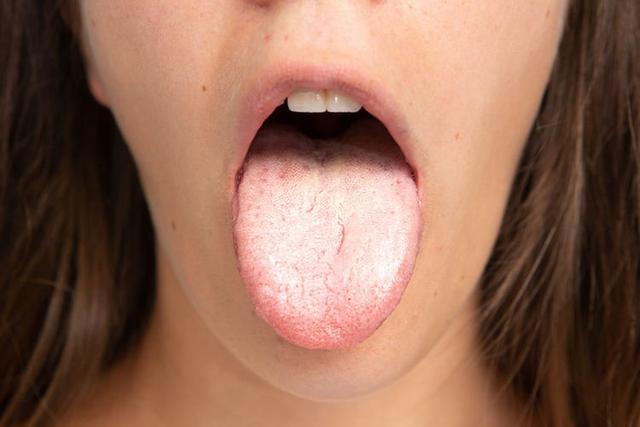 舌苔颜色反映身体疾病｜舌苔变白会易患感冒 苔苔黄即是肠胃差？