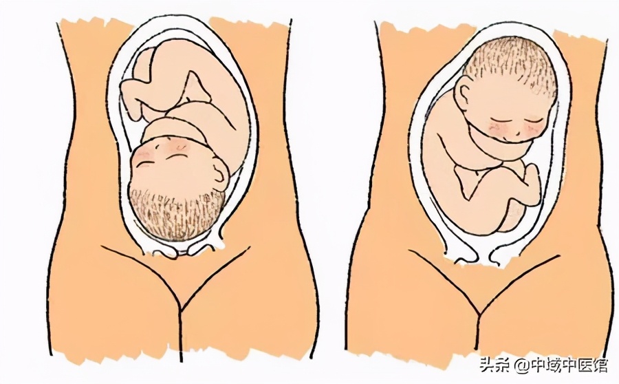 是胎位不正的一种情况,胎儿臀位虽然对胎儿的健康发育并没有什么影响