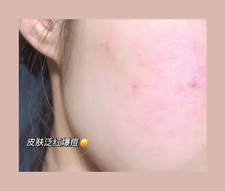 Semi Rotted Face Don't believe these skin care rumors, rotten face, acne, and spicy ...
