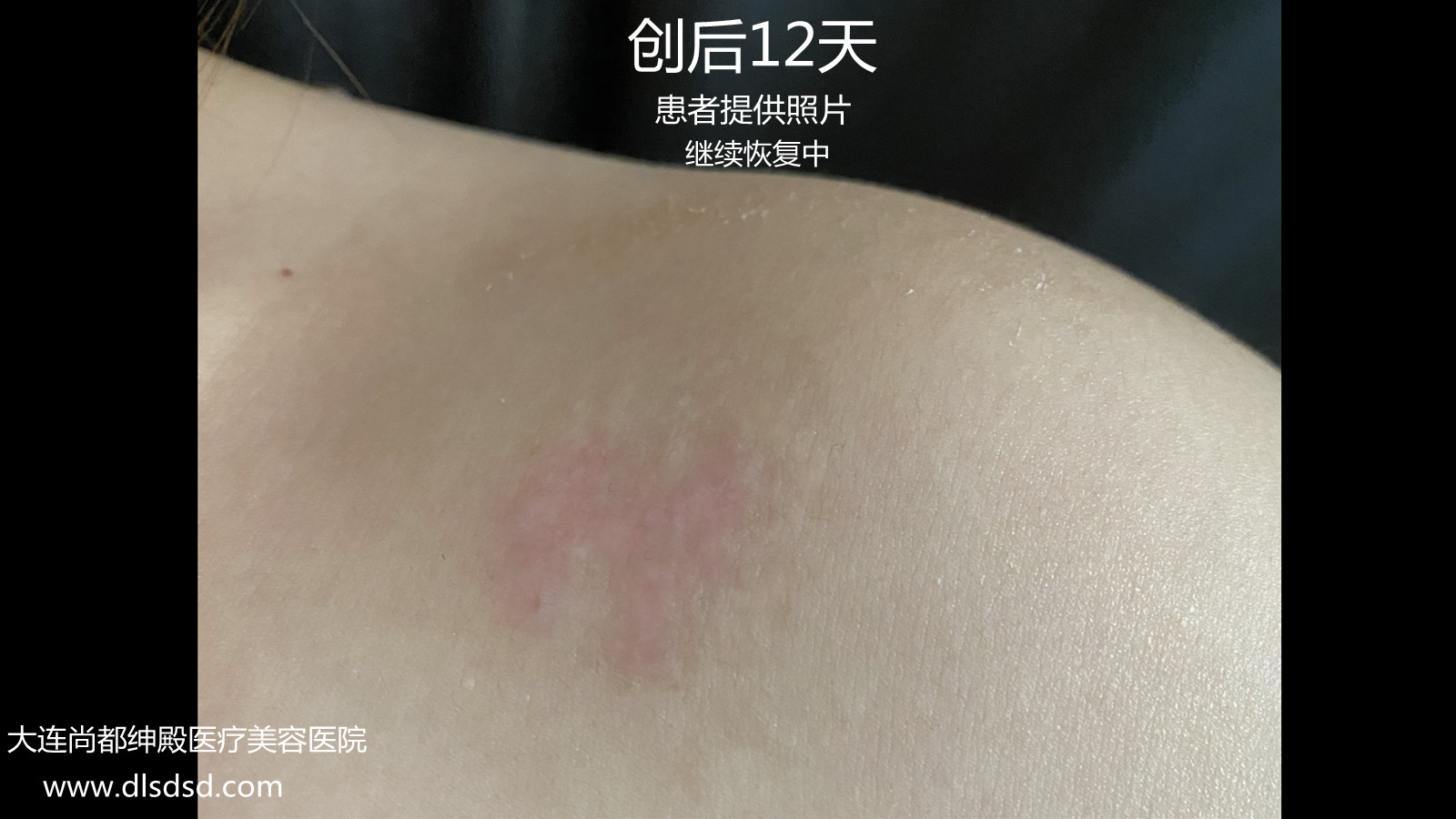 Can a black tattoo be completely washed off? It will look like a few