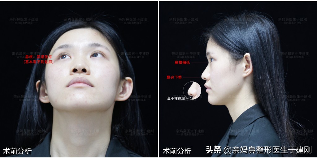 Ear cartilage rhinoplasty!Goodbye my nose, it's not that I don't like