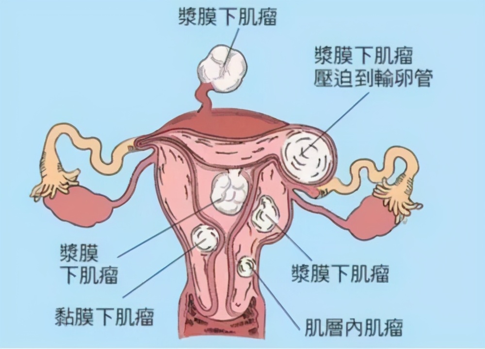 The "culprit" that contributes to uterine fibroids is not soy milk, listen to the gynecologist