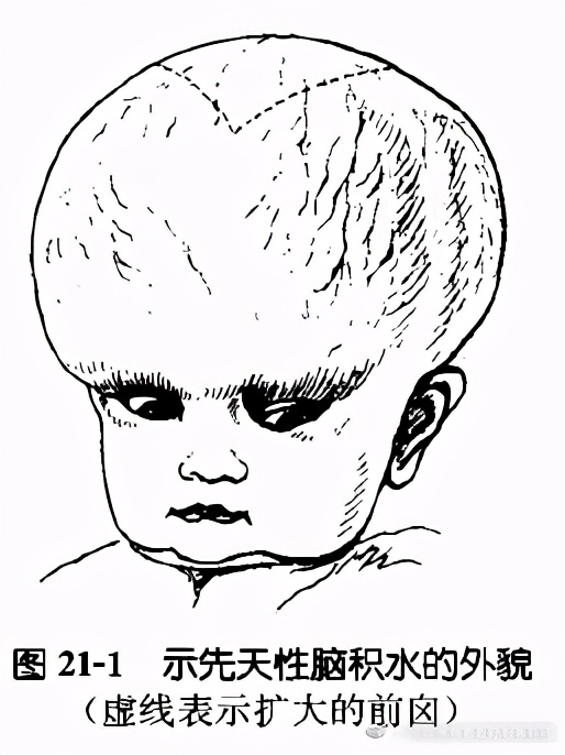 落日目现象透光实验脑积水磁共振表现什么是脑积水小儿脑积水是一类