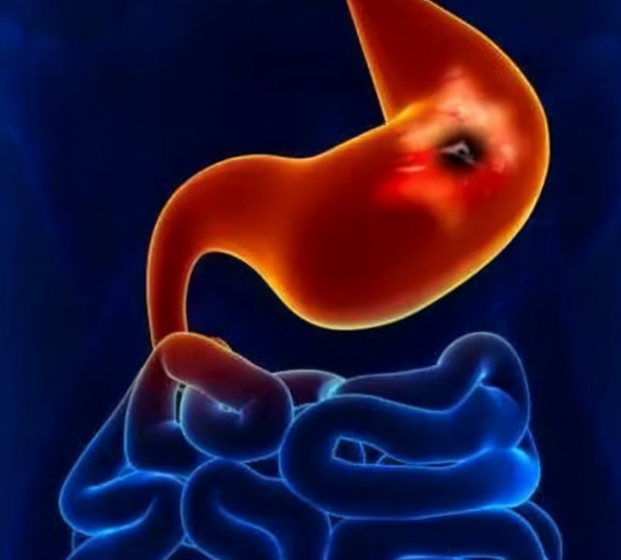 "Fungus" is the cause of stomach disease?Reminder 3 kinds of food that