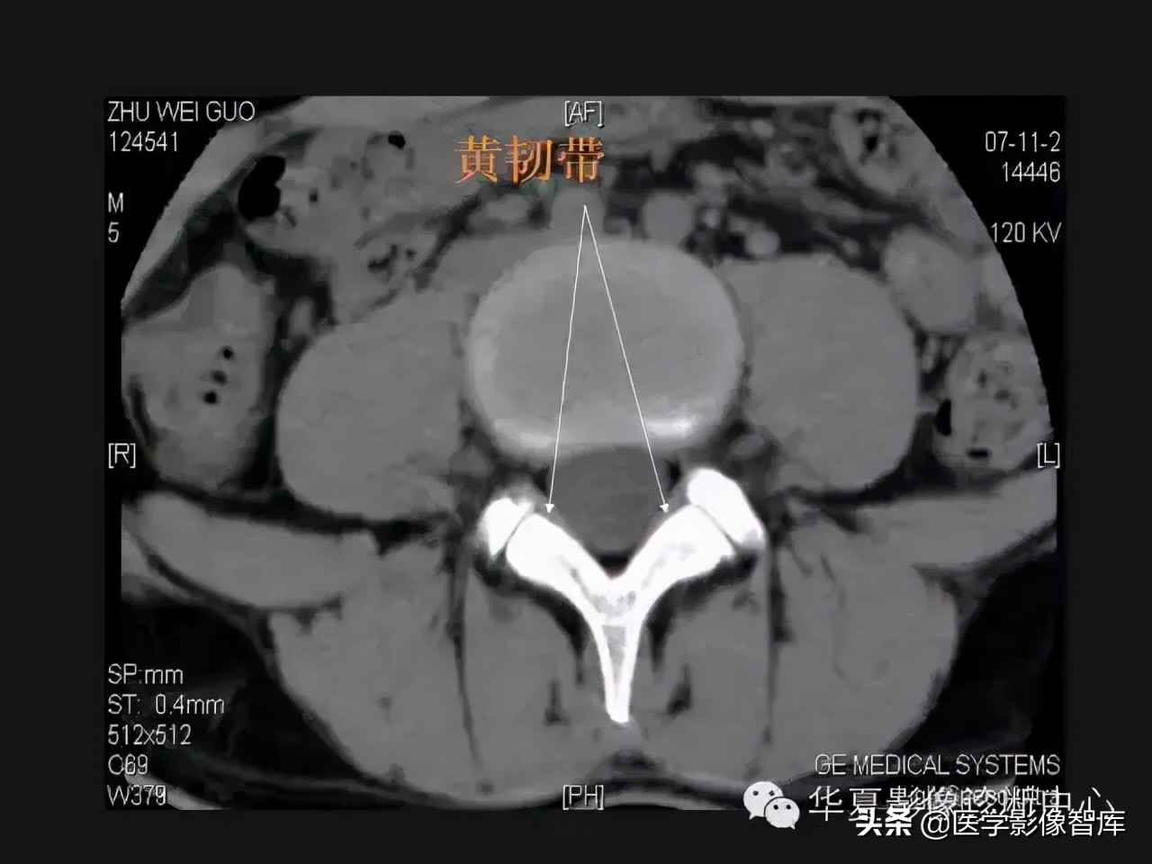 Lumbar imaging anatomy and common lesions iNEWS
