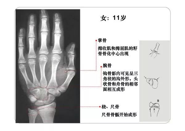 Bone Age Atlas (Revised Version) - iNEWS