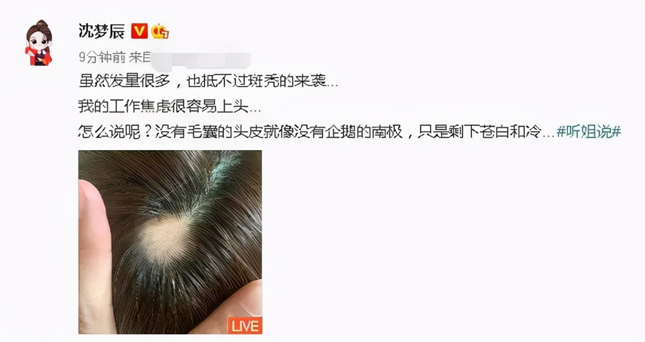 It turns out that celebrities will also have a terrible bald crisis - iNEWS