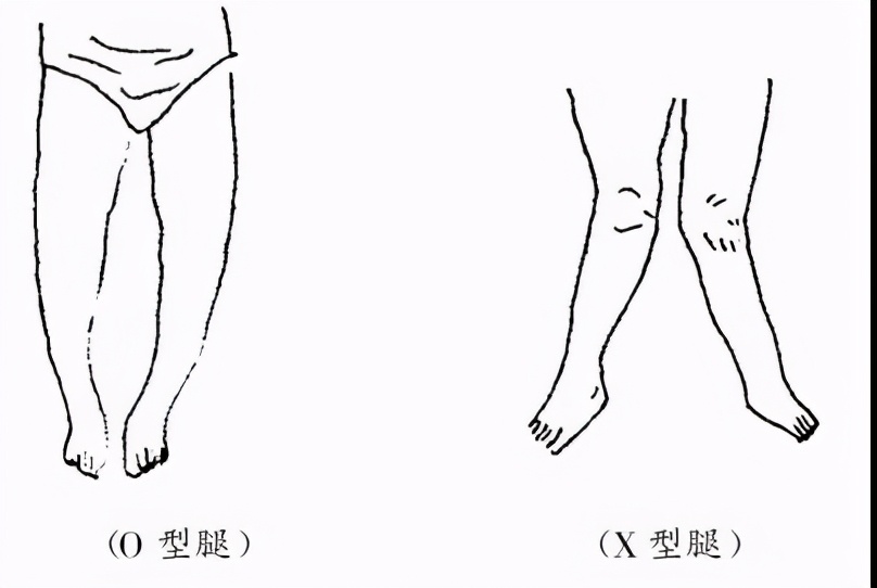 Madison Health How much do you know about your baby's Oshaped legs and Xshaped legs? iNEWS