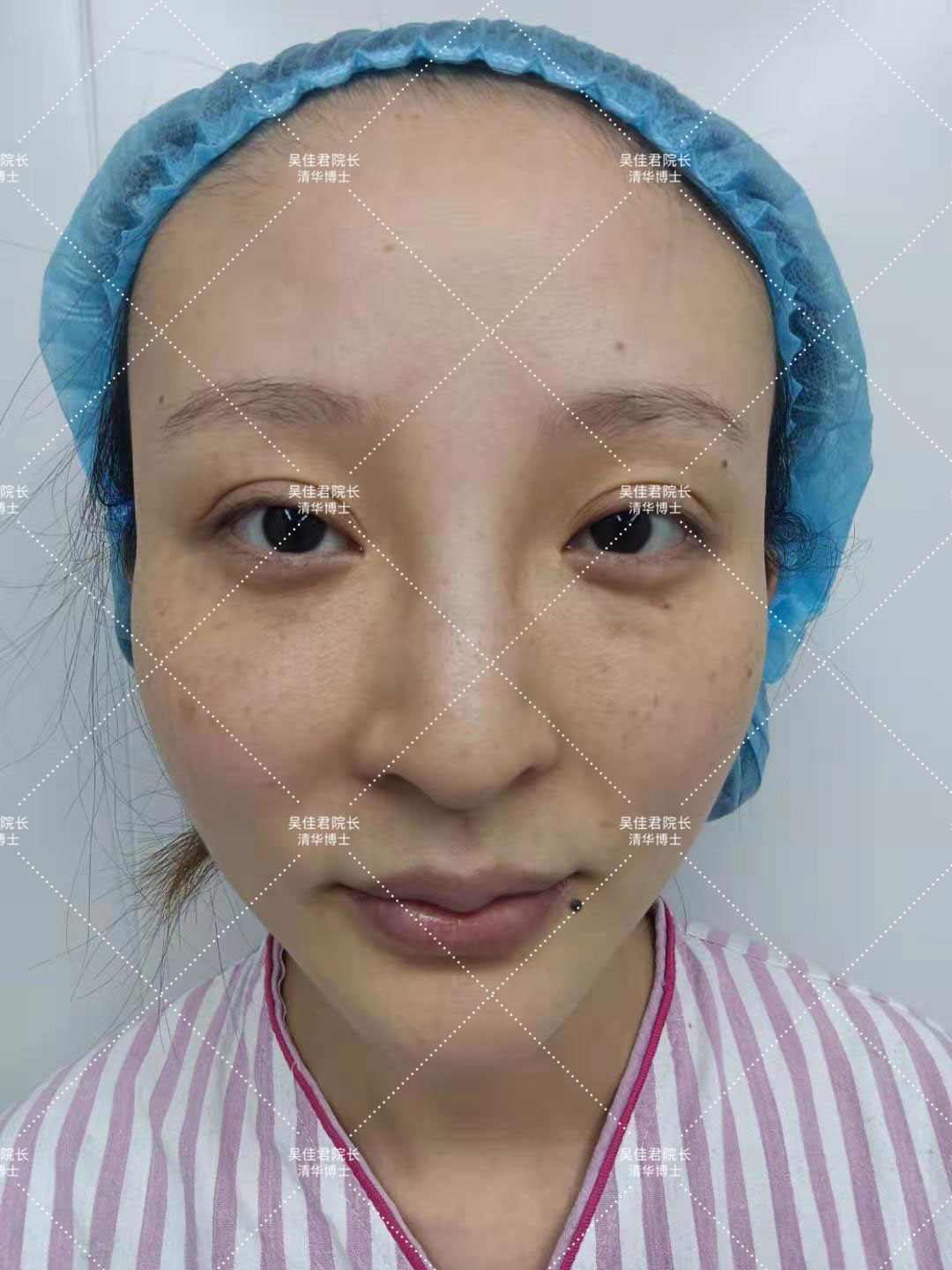 At the age of 32, open the whole process of small face lift + platysma