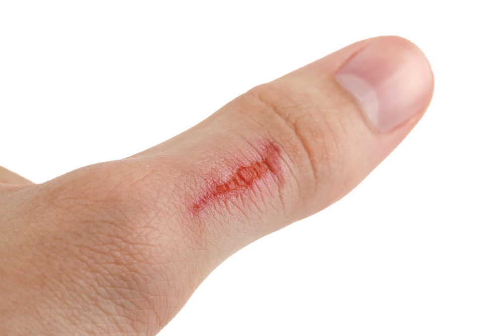 New glue can stop bleeding in 15 seconds iNEWS