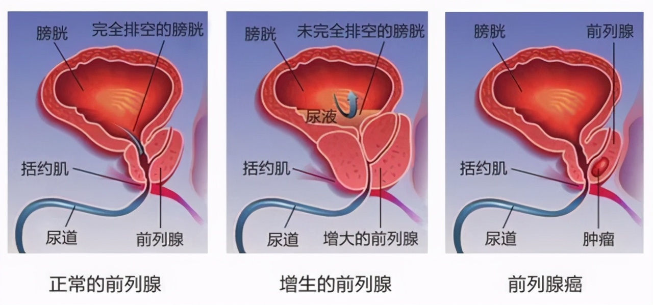 Prostate Calcification How is prostate calcification caused?What is the specific performance ...