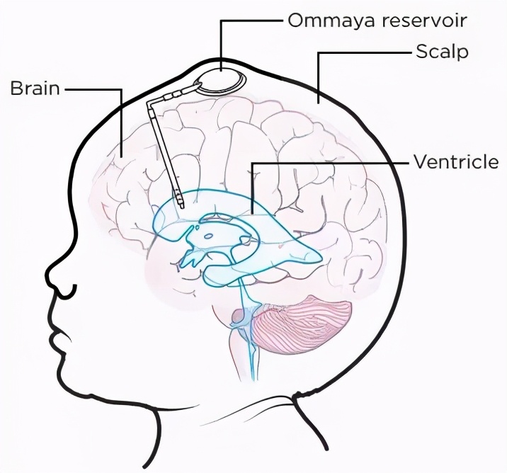 健康学堂丨娃娃"头大"=聪明?当心"脑积水" - 父母学堂 - 广西妇幼保健