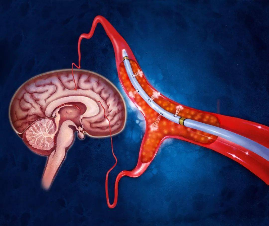 What Is A Cerebral Infarction How Should Patients With Cerebral 