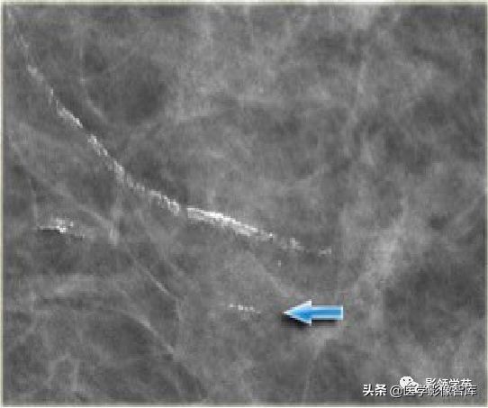 Differential diagnosis and grading of breast calcification - iNEWS