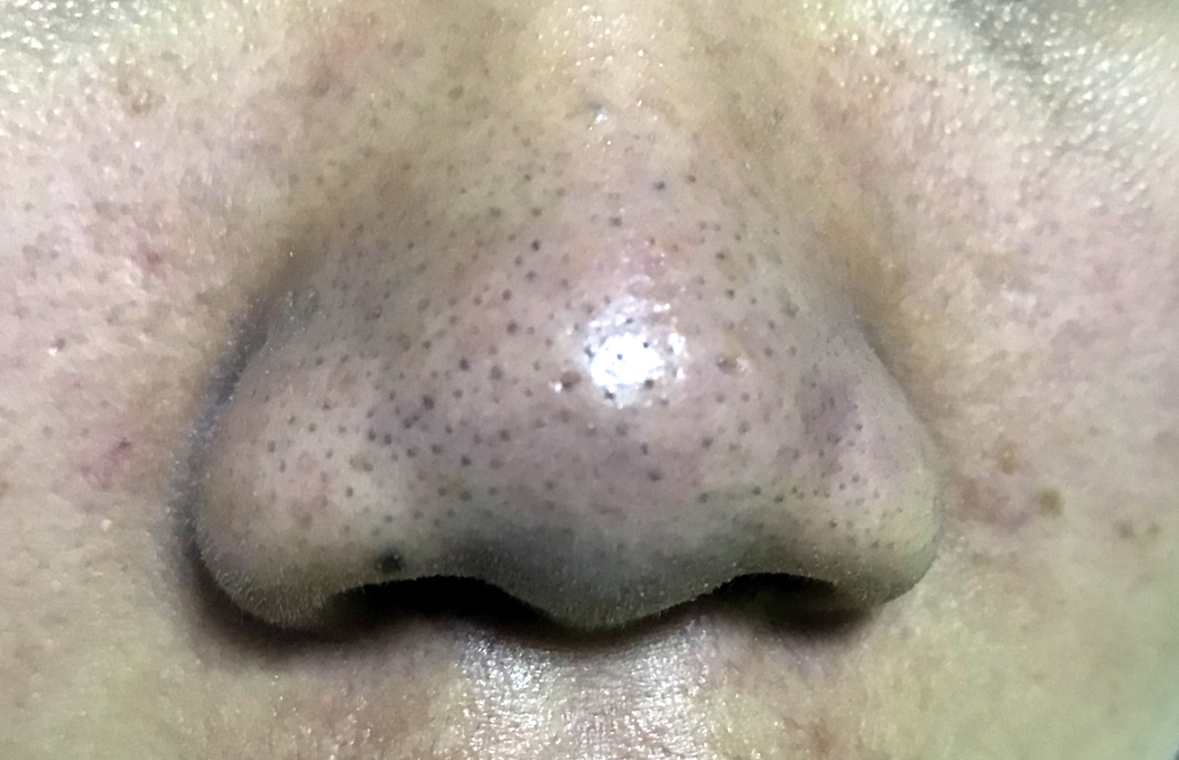 Why is it said that the more you squeeze the blackheads, the bigger