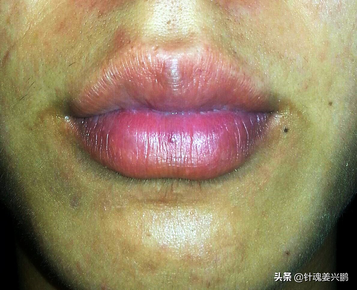 Heart Problem Lips Whether there is a problem with the heart, compare the 5 conditions one ...