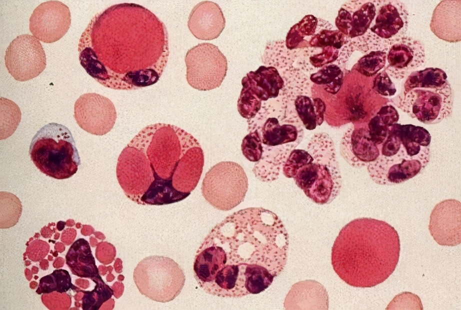 Selective IgA deficiency is related, and patients are prone