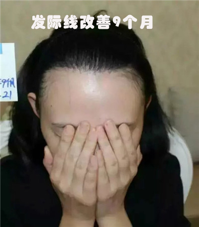 女生天生秃鬓角近几年脱发严重发际线明显后移还有救吗