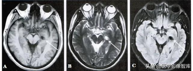 Imaging Diagnosis Of Choroidal Fissure Cyst Inews