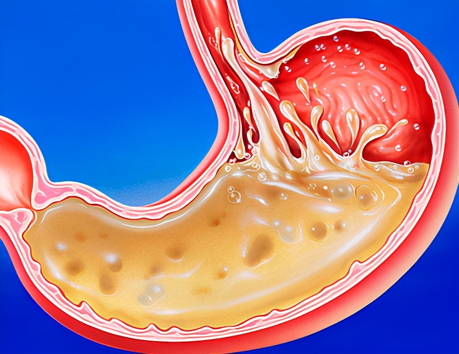 Does eating pickles cause stomach pain?Gastroenterologist These 3